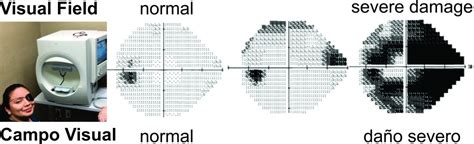 visual field test prep